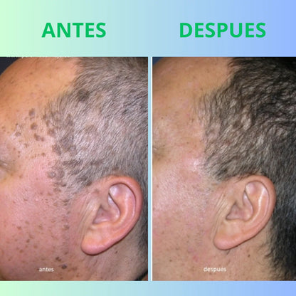 POTENTE TRATAMIENTO WART REMOVER